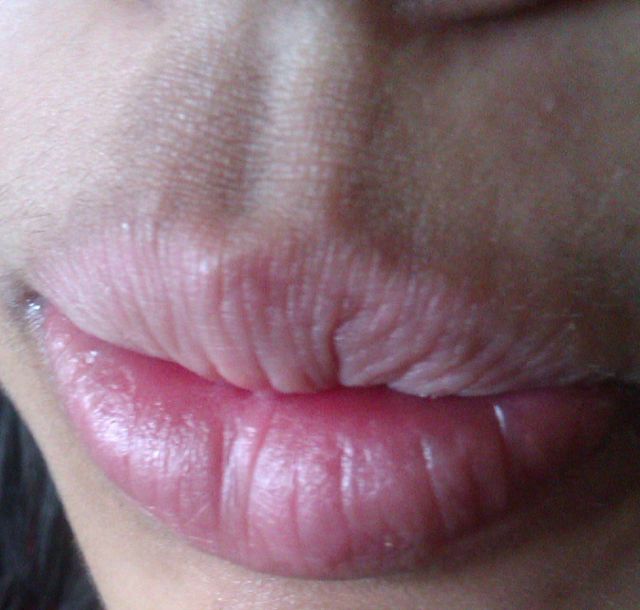 Eczema deals lip treatment